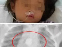 6歲女兒突然暴瘦！去醫院檢查時，醫生讓孩子摘掉「項鏈」，爸媽急了：孩子沒戴啊