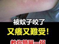 被蚊子咬了又癢又難受，教你簡單一招！