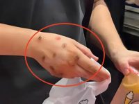 買奶茶驚見店員手背佈滿「黑色圓疤」!網友嚇瘋:快丟掉別喝 買奶茶驚見店員手背佈滿「黑色圓疤」!網友嚇瘋:快丟掉別喝