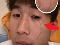 男子失戀後竟從眼中哭出「黑線」！醫生緊急手術：再晚就來不及了！